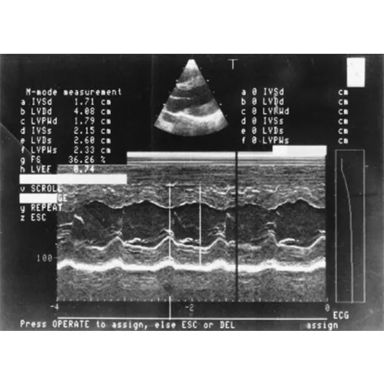 MICM (Maternally Inherited Cardiomyopathy) Mutation Detection
